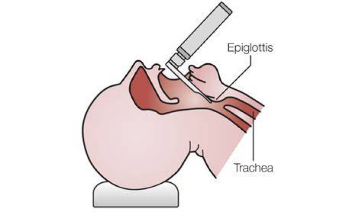 Do you intubate epiglottitis?