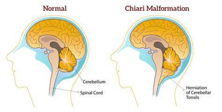 Do you qualify for disability with chiari malformation?