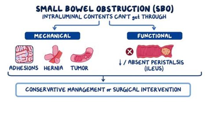Does a bowel obstruction require surgery?