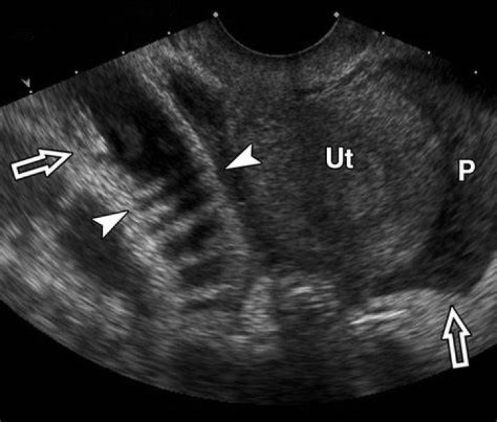 Does a pelvic ultrasound show the bowel?