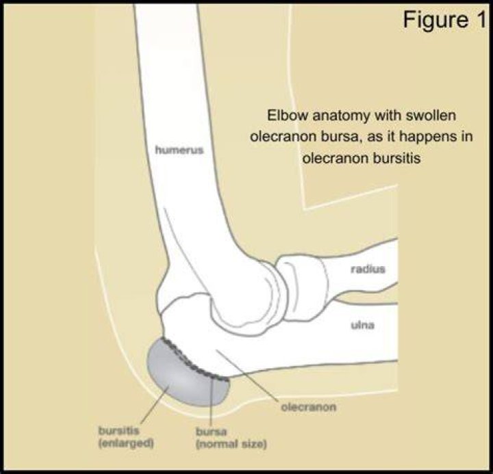 Does a ruptured bursa sac heal itself?