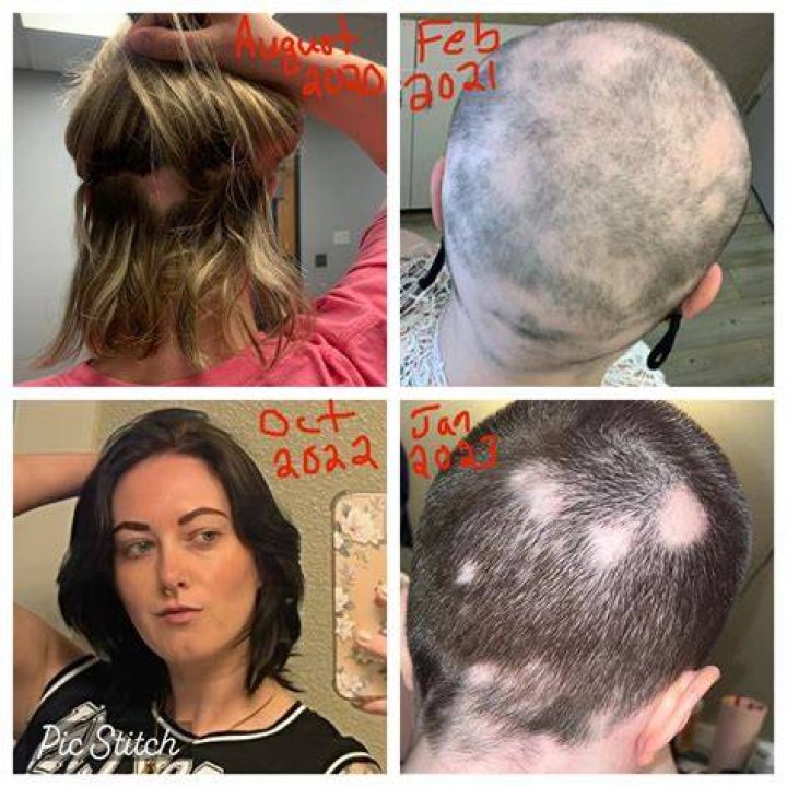 Does alopecia spread quickly?