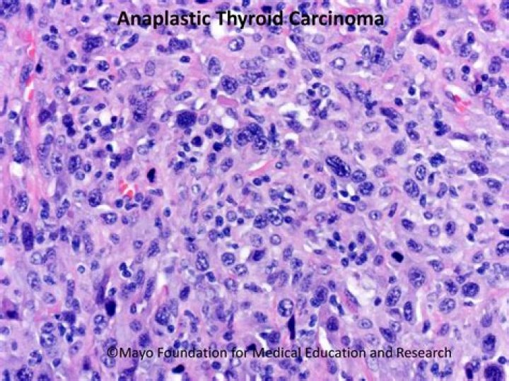 Does anaplastic thyroid cancer run in families?