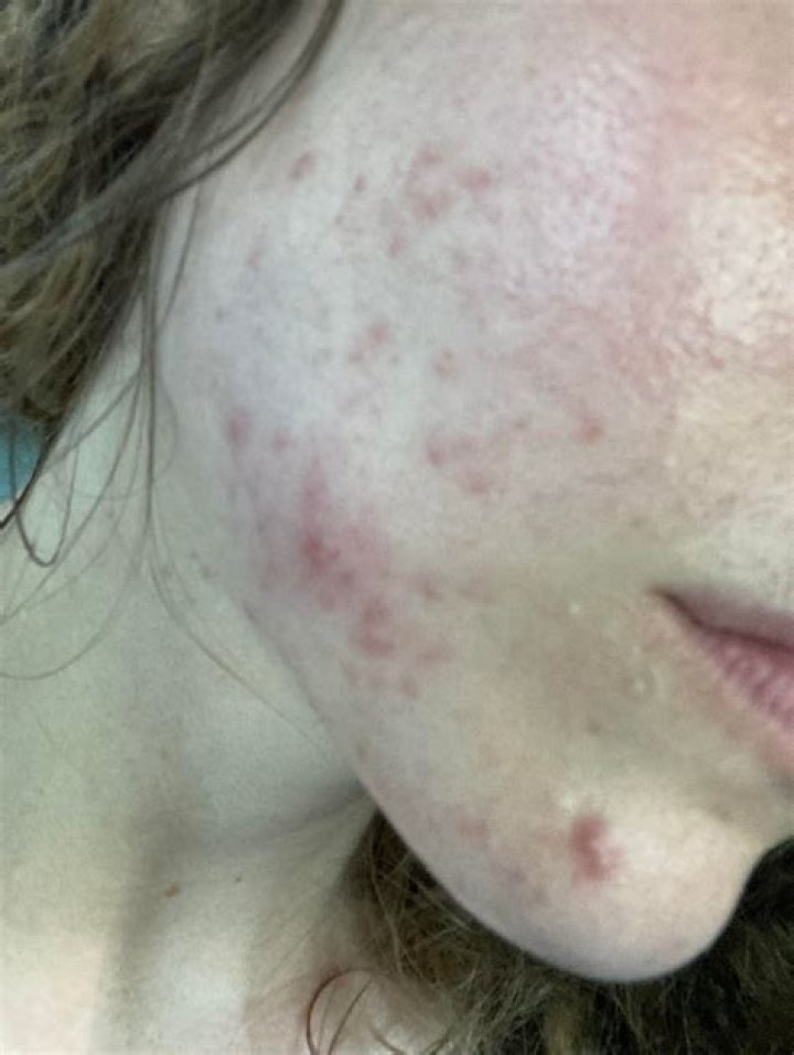 Does azelaic acid cause purging?