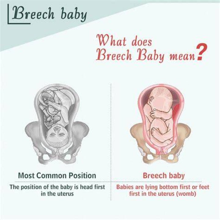 Does breech mean something wrong baby?