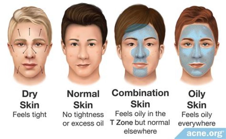 Does consuming oil cause acne?