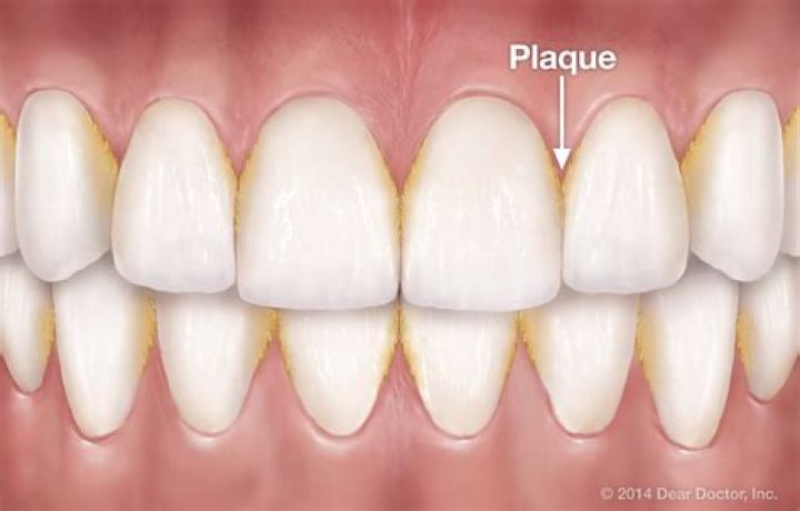 Does flossing remove plaque?