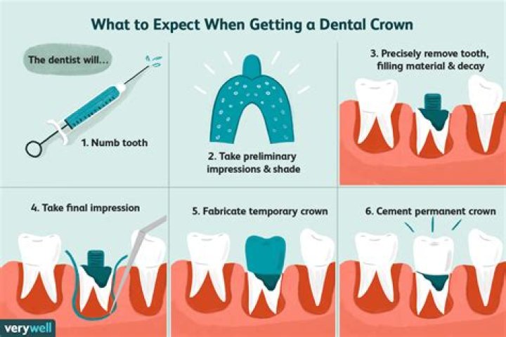 Does getting a crown hurt?