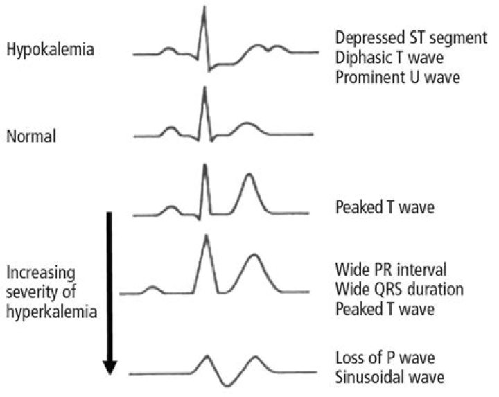 Does hyperkalemia cause bradycardia?