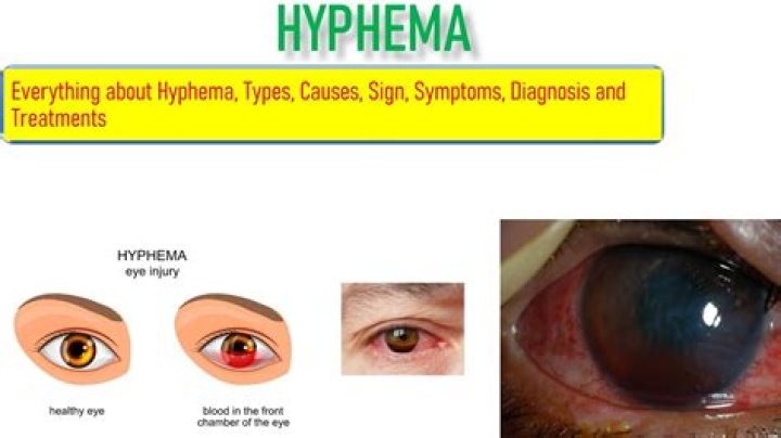 Does hyphema need surgery?