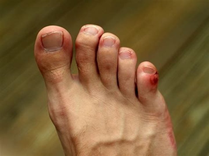 Does ice help a stubbed toe?