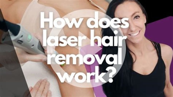 Does laser hair removal work permanently?