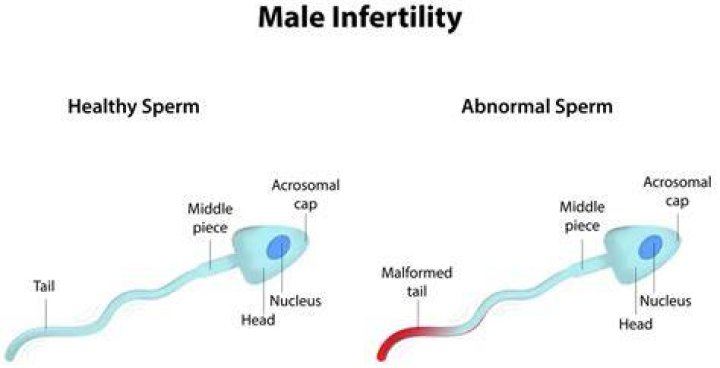 Does measles cause infertility in males?