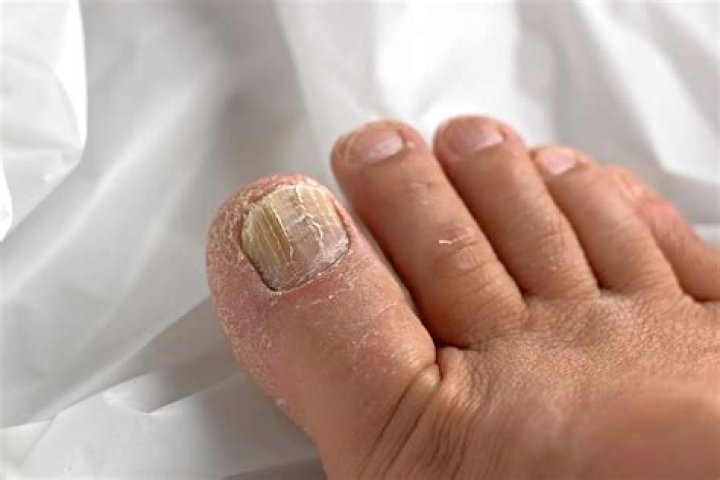 Does nail fungus hurt?