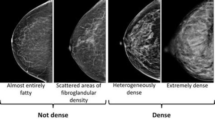 Does nodular density mean cancer?