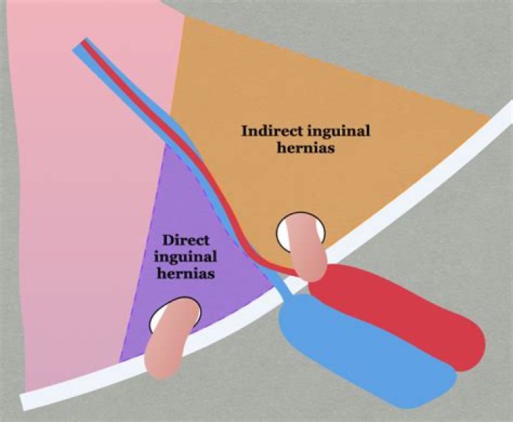 Does reducible hernia need surgery?