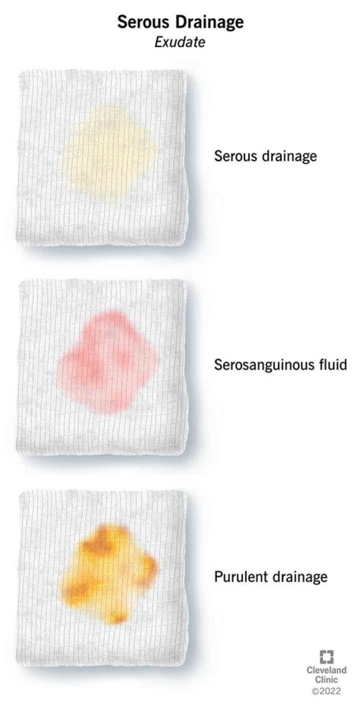 Does serosanguineous drainage indicate infection?