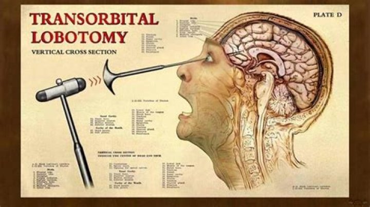 Does teddy get a lobotomy?