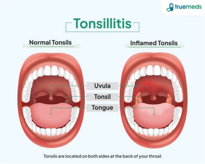 Does tonsillitis last long?