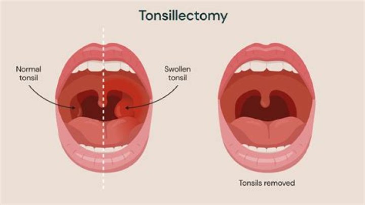 During tonsils nose block?