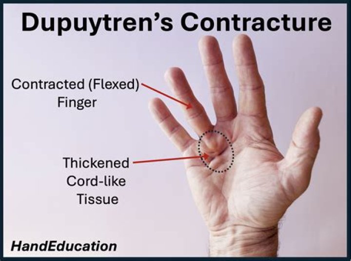 How can dupuytren's be prevented?