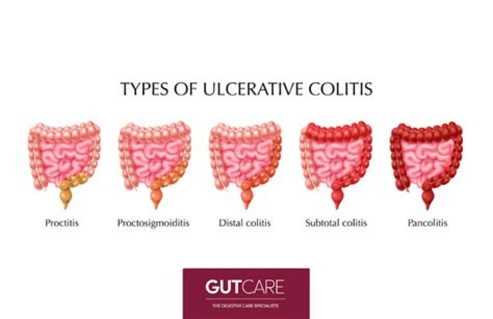How can ulcerative colitis be cured?