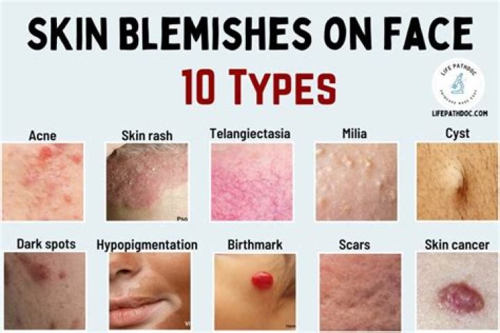 How do i get rid of blemishes?