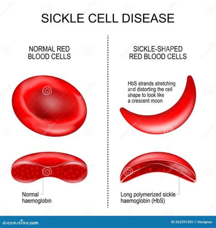 How do sickle look like?