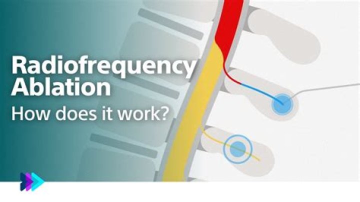 How does radiofrequency work?