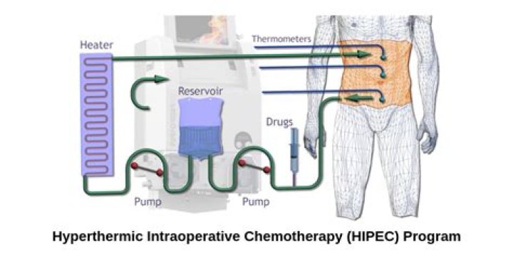 How effective is hyperthermic intraperitoneal chemotherapy?