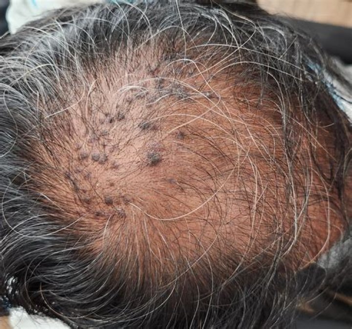 How follicles are measured?