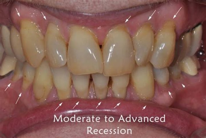How is gingival recession treated?