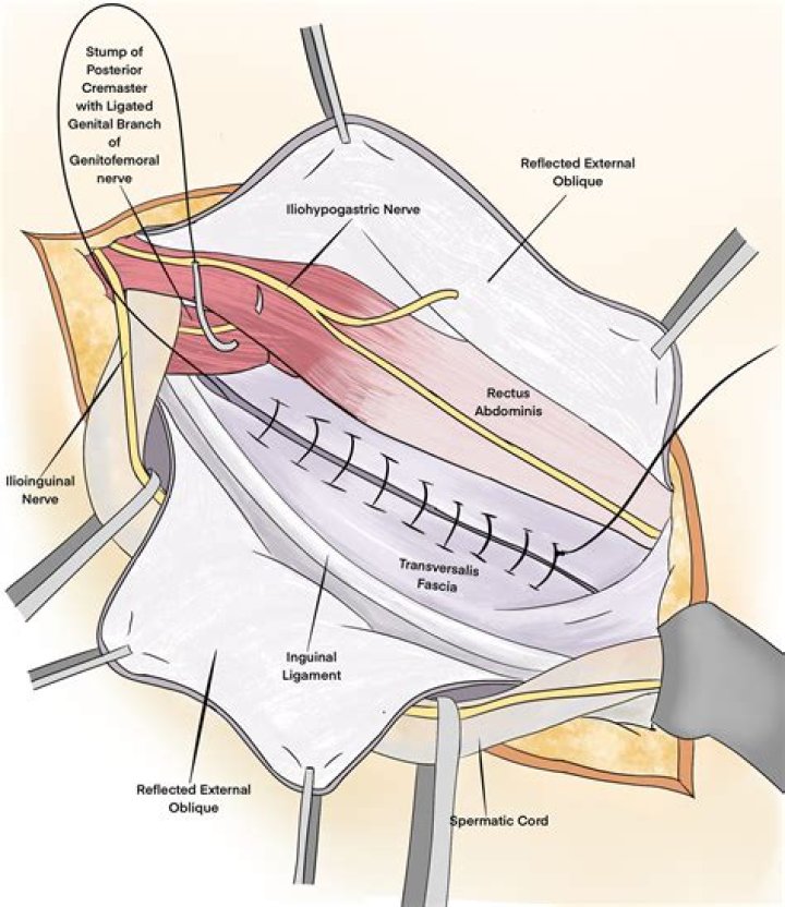 How is herniorrhaphy done?