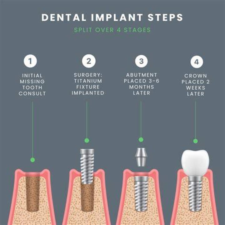 How long does latera implant last?