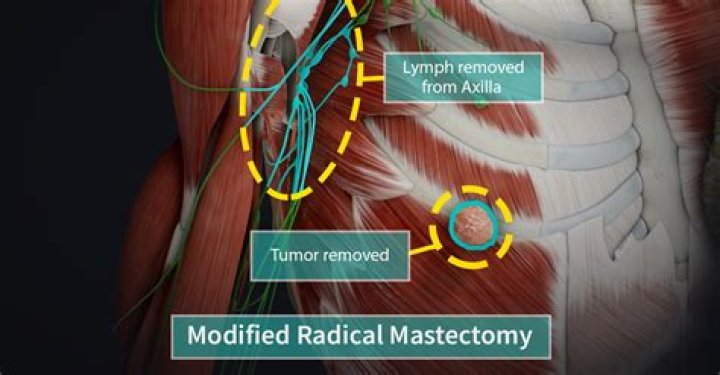 How long does mastectomy surgery take?