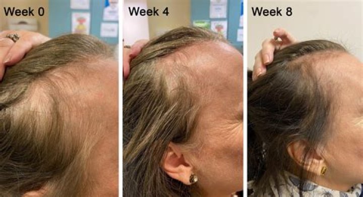 How many sittings for prp hair?