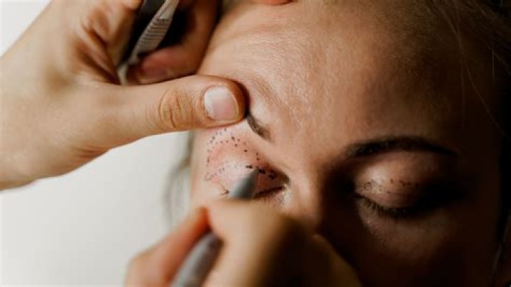 How much does it cost to have sclerotherapy?