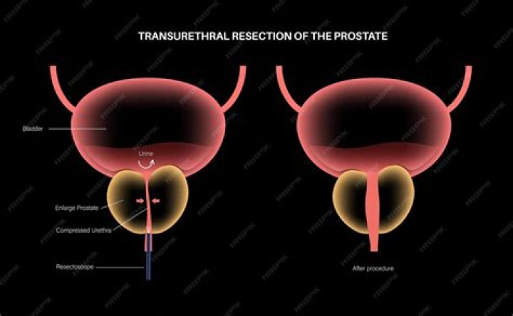 How much is a prostate operation?