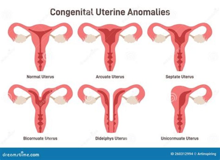 How rare is a bicornuate uterus?