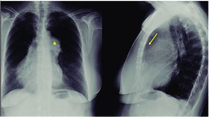 How rare is mesocardia?