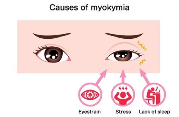 How rare is superior oblique myokymia?