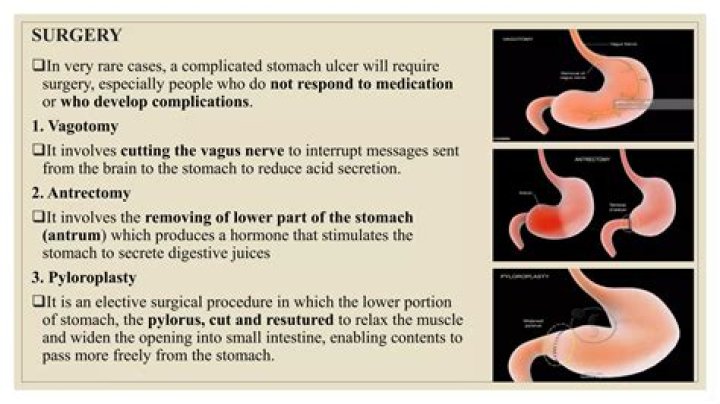 How to do antrectomy?