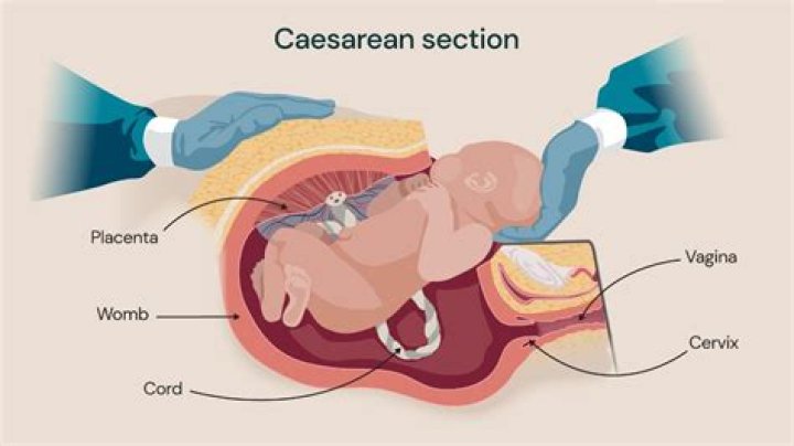 How to get rid of post cesarean belly?