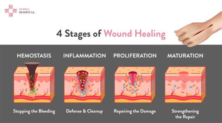 How to heal peristomal skin?