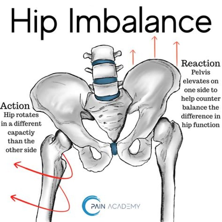 How to tell if hip is out of place?