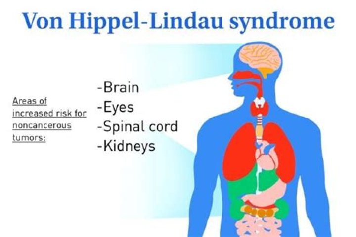 How to test for von hippel lindau syndrome?