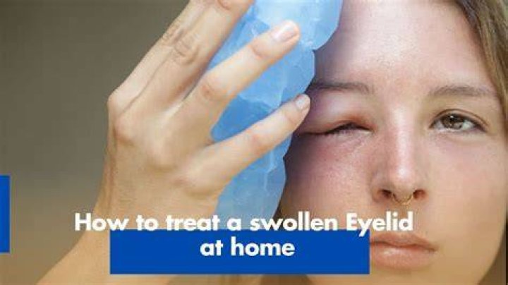How to treat a swollen shut eye?