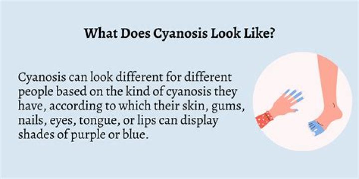 How to treat cyanotic?