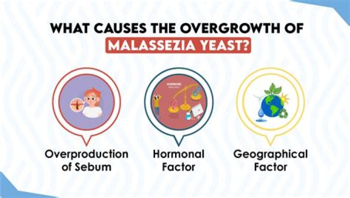 How to treat malassezia furfur?