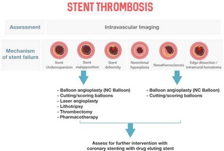 In stent thrombosis classification?
